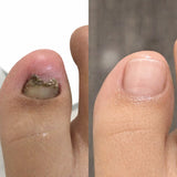 FungiClear: pomadas para los hongos en las uñas| Elimina hasta el 98 % de los hongos en las uñas en solo 8 días
