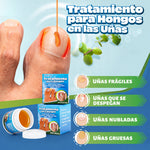 Crema para el tratamiento de hongos en las uñas